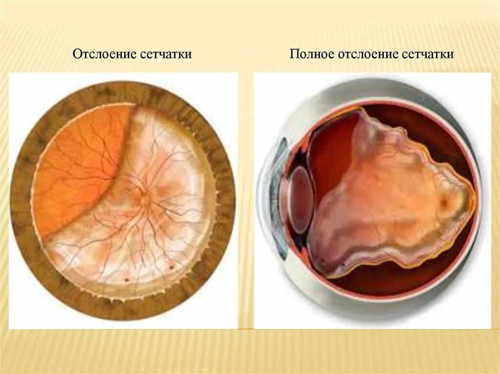 Регматогенная отслойка сетчатки глаза. Воронкообразная отслойка сетчатки. Отслойка сетчатки зрение. Пациент с отслойкой сетчатки.