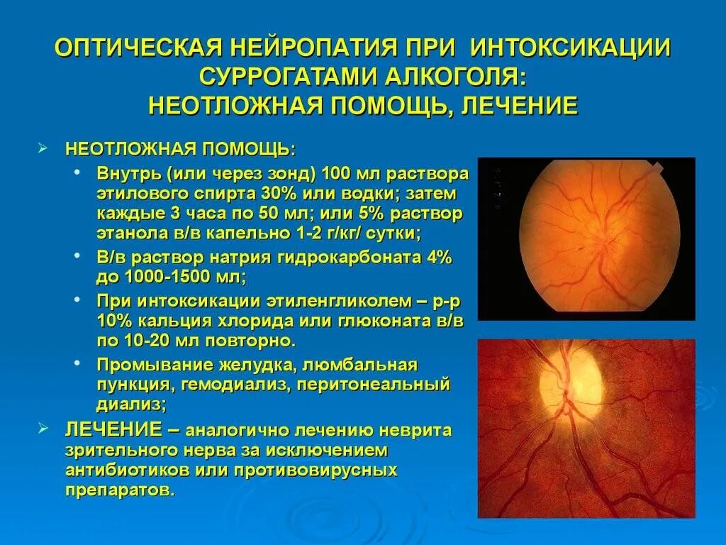 Задняя ишемическая нейропатия зрительного нерва. Ишемическая нейрооптикопатия глаза. Задняя ишемическая нейропатия глазное дно. Ишемическая нейропатия оптического нерва. Нейропатия глаза