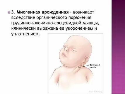Кривошея у новорожденных лечение