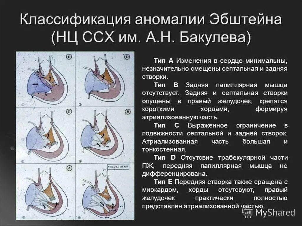 Аномалия Эбштейна классификация. Аномалия Эбштейна ЭХОКГ признаки. Аномалия Эбштейна сердце классификация. Аномалия Эбштейна ЭХОКГ Тип а.