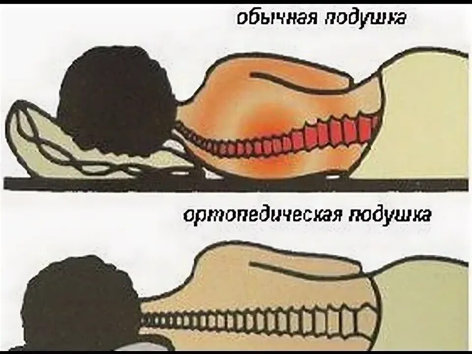 Как правильно спать при шейном остеохондрозе. Подушка при лордозе шейного отдела позвоночника. валик при остеохондрозе шейного отдела. правильное положение позвоночника при сне. ортопедическая подушка при сколиозе.