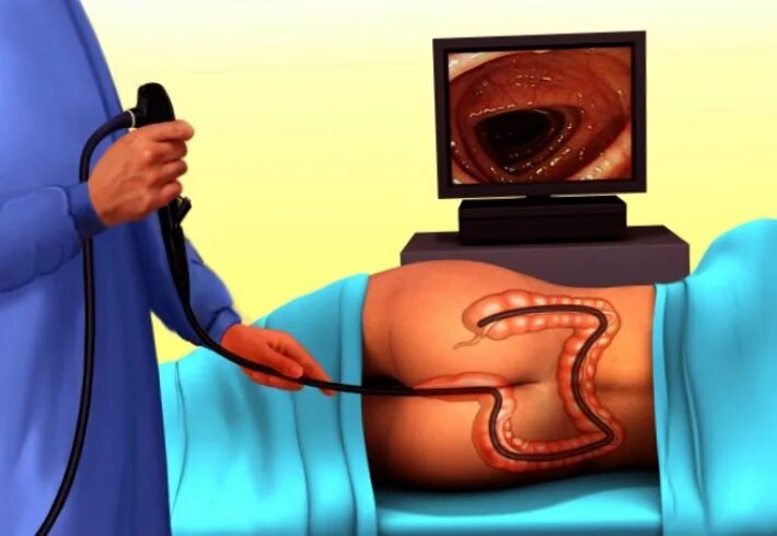 Колоноскопия толстой кишки. Колоноскопия прямой и толстой кишки. Как делаются кишки. Эндоскопическое исследование толстой кишки колоноскопия. Как делаются кишки.