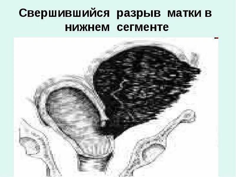 Разрыв матки в Нижнем сегменте. Свершившийся разрыв матки. Клиника совершившегося разрыва матки. Механический разрыв матки.