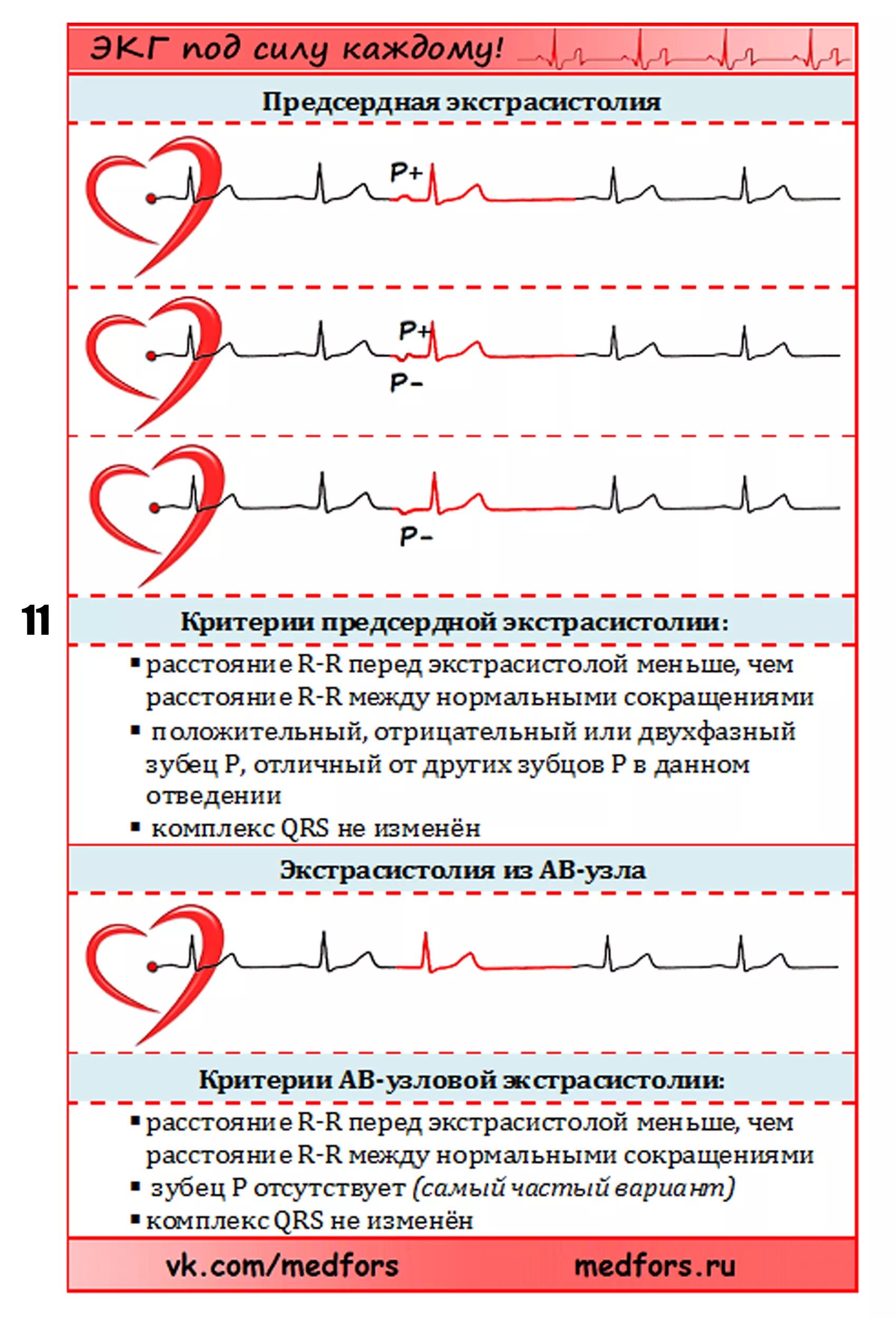 отведения в экг расшифровка. экг с нуля. нормальная экг зубцы сегменты интервалы. кардиограмма сердца норма и патологии. экг с нуля.