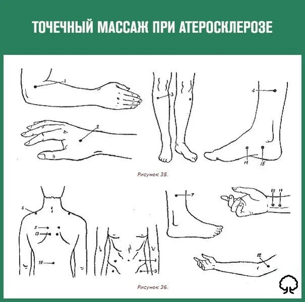 Можно ли делать массаж при атеросклерозе. Методика точечного массажа. акупрессура при атеросклерозе сосудов.