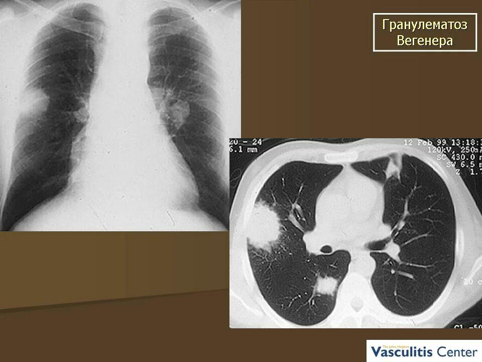 Синдром Вегенера рентген. Лимфогранулематоз Вегенера. Васкулит вегенера