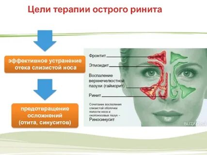 Осложнения острого синусита
