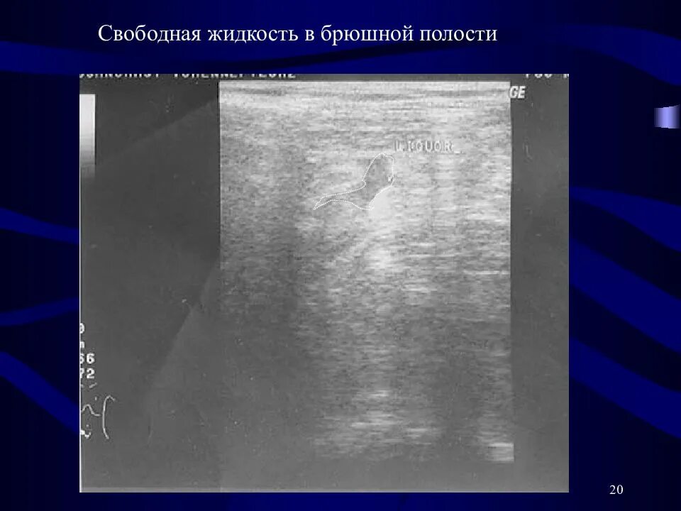 Почему скапливается жидкость в брюшной. Жидкость в брюшной полости на узи. свободная жидкость в брюшной полости. эхопризнаки свободной жидкости в брюшной полости. осумкованная жидкость в брюшной полости узи.