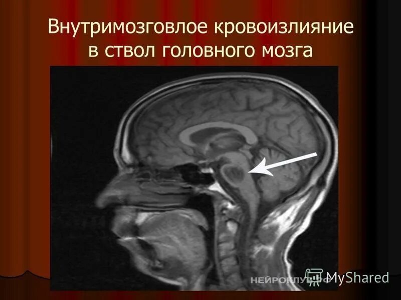 Стволовой инсульт прогноз. Ишемический инсульт ствола головного мозга на мрт. Кровоизлияние в ствол головного мозга на кт. Стволовой ишемический инсульт на кт. Геморрагический инсульт в стволе кт.