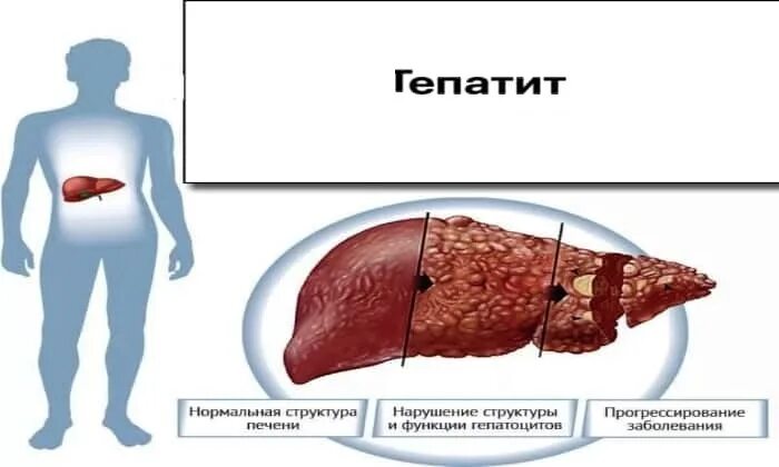 Токсический печени симптомы. Токсический гепатит печени. Хронический токсический гепатит. Токсический гепатит симптомы.