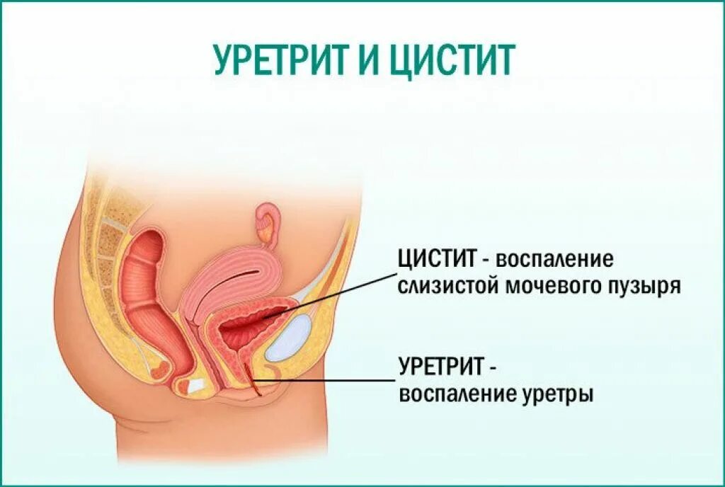 Канал мочи у мужчин. Женский мочеиспускательный канал. Мочевой канал у женщин. Воспаление мочеиспускательного канала у женщин.