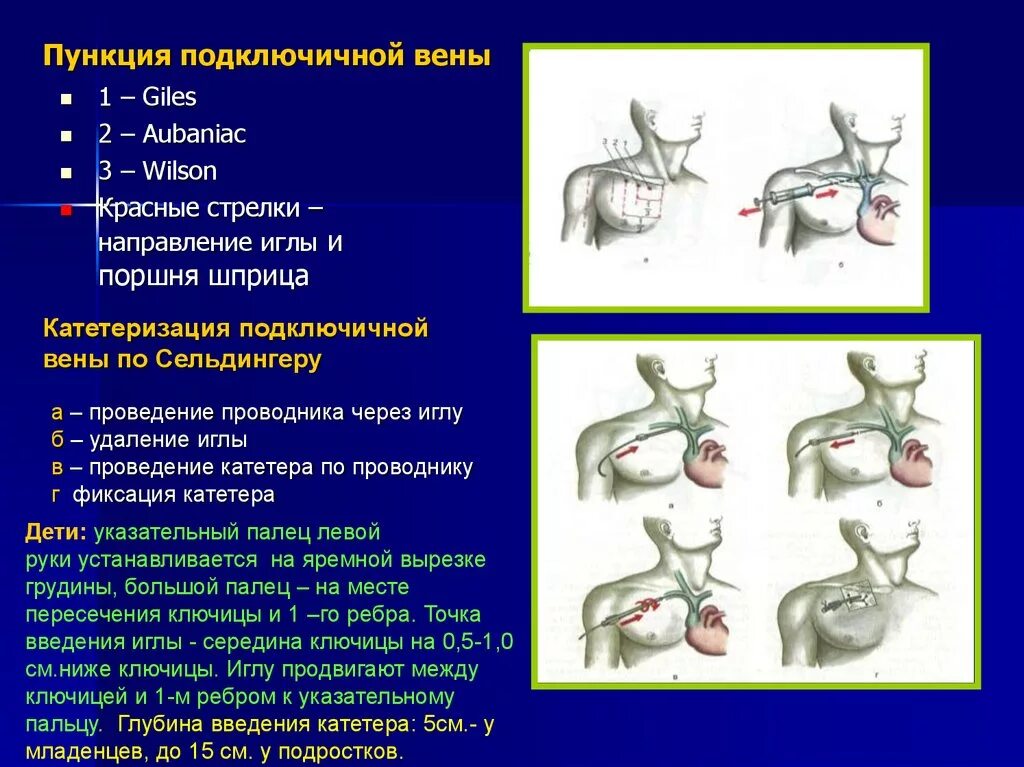 Введение подключичного катетера