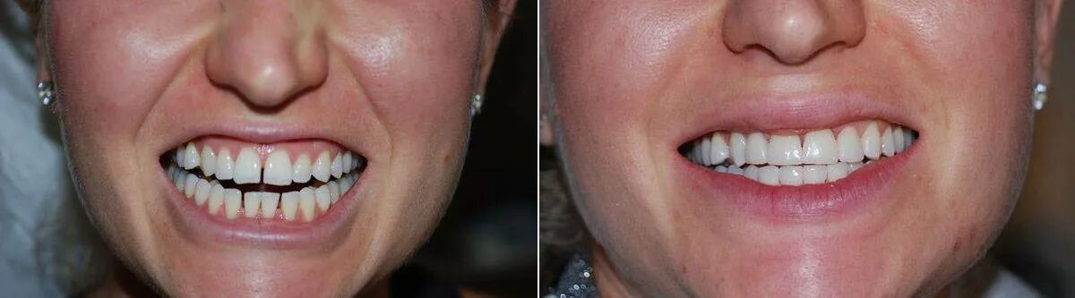 Виниры стачивание зубовато. Композитные виниры на передние зубы. Стачиваются ли зубы. Виниры стачивание зубовато. Стачиваются ли зубы.