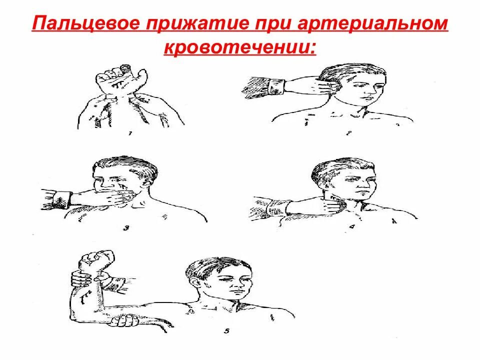 Пальцевое прижатие при кровотечении. Артериальное кровотечение пальцевое прижатие. пальцевое прижание при кров. пальцевые прижатия при артериальном кровотечении.