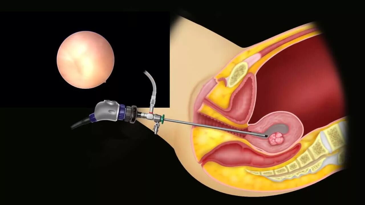 Удаления полипа эндометрия гистероскопией