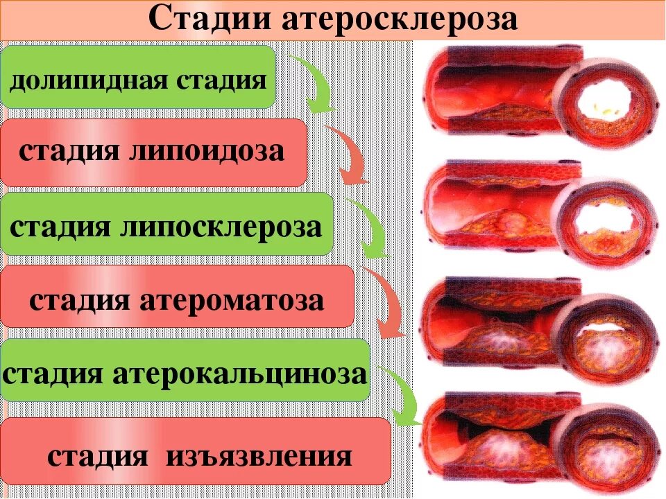 Атеросклеротические изменения сосудов. Атеросклероз периоды развития. Стадии развития атеросклеротической бляшки. Липоидоз стадия атеросклероза. Характеристика стадий атеросклероза таблица.