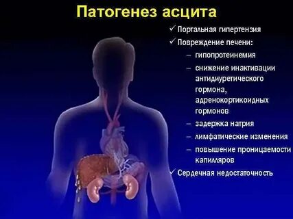 Асцит печени патогенез