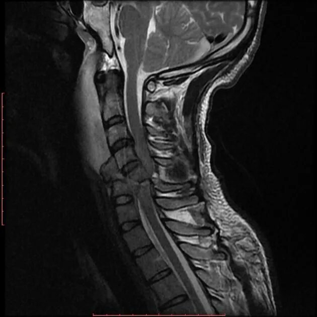 Остеофиты на мрт позвоночника. Limbus vertebra мрт. Мрт позвоночника Аксиал. Рассеянный склероз шейного отдела мрт.