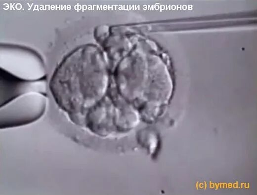 Эмбрион после пересадки. Эмбрион при эко. Подсадка эмбрионов при эко. Фрагментация эмбриона. ИКСИ эмбрион.