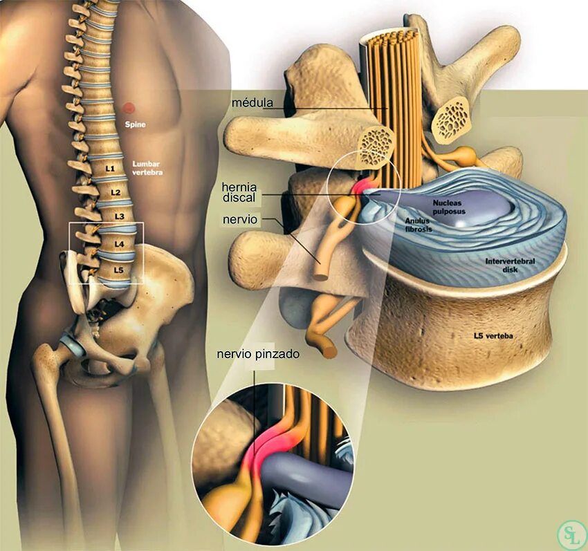Корешковые нервы в пояснице. Межпозвонковый диск l5-s1. Межпозвонковые диски l5-s1. Экструзия диска l5-s1 9мм. Позвоночные диски l5-s1.