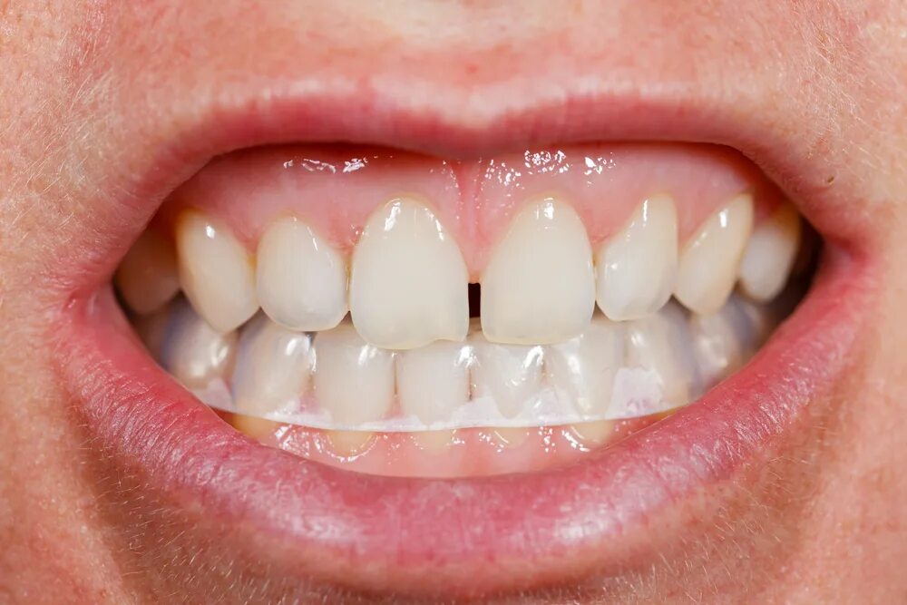 Скрипит зубами во сне причины. Скрежетание зубами во сне. Почему во сне сжимается челюсть. Брюксиз. Брюксиз.