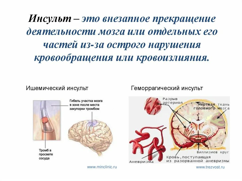 4 года инсульт. Инсульт. Причины мозгового инсульта. Предпосылки ишемического инсульта.