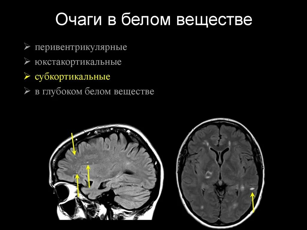 Без перифокальной реакции. Субкортикальные очаги головного мозга. Субкортикальные очаги в белом веществе головного мозга мрт. Очаги глиоза в головном мозге мрт. Демиелинизация спинного мозга мрт.