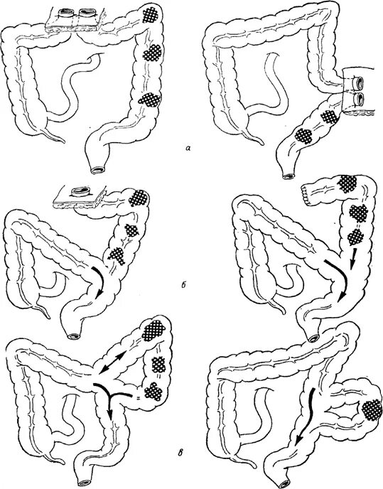 Операция толстой. Операции на толстой кишке. Операции на толстом кишечнике схема. Радикальные операции на толстой кишке.