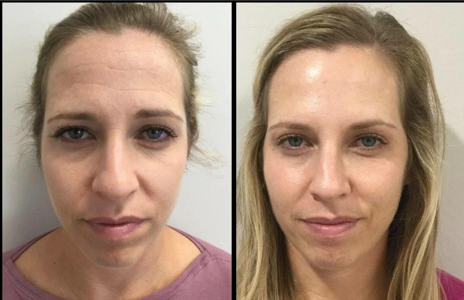 Women are now having 'Upside Down Botox' to banish their resting b*tch face and 
