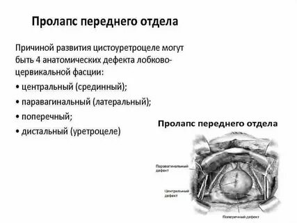 Пролапс задней стенки