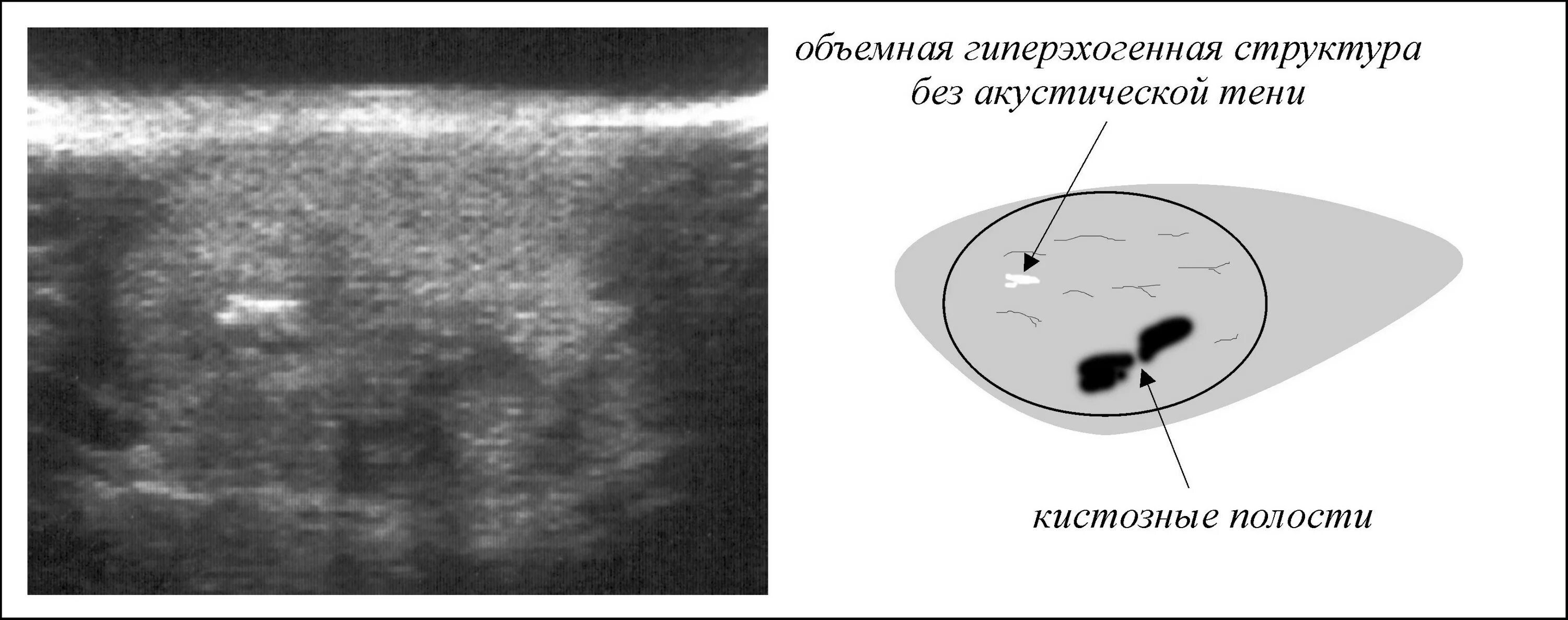 Образование без акустической тени. Гиперэхогенное образование на УЗИ. Гиперэхогенная структура на УЗИ. Гиперэхогенные линейные структуры. Гиперэхогенные структуры на УЗИ печени.