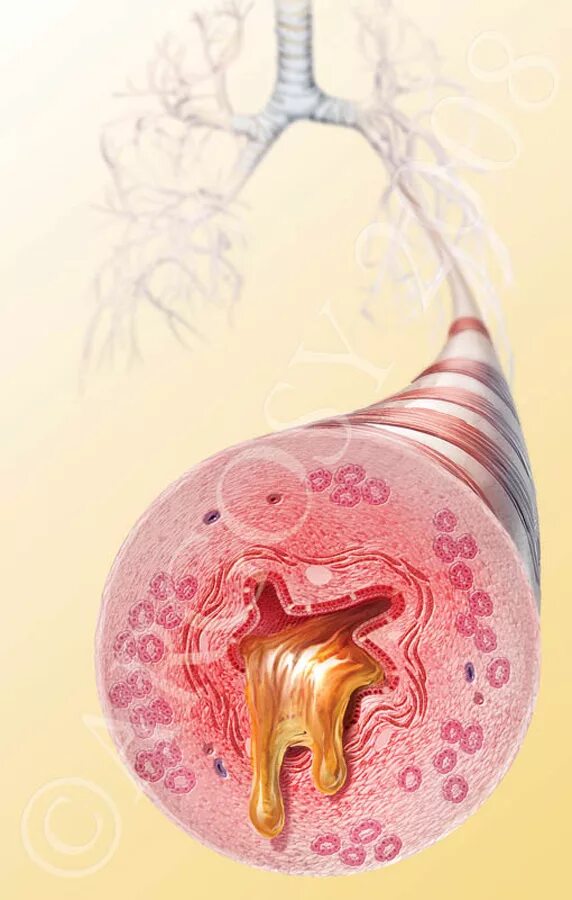 Скопление мокроты в бронхах. В просвете слизь