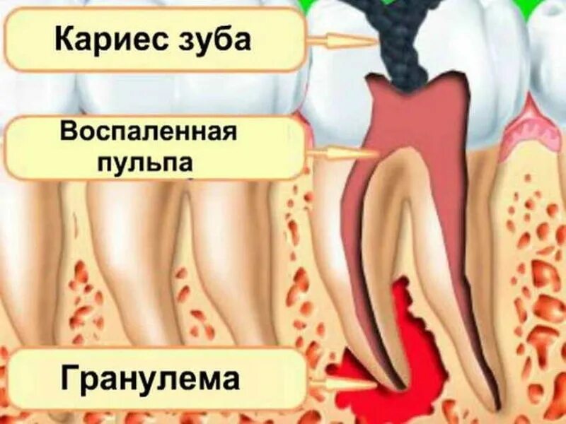 Межкорневая гранулема. Гранулема корня зуба снимок. Воспаление леченого корня зуба.