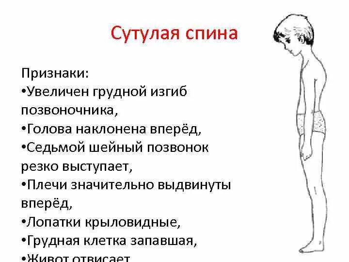 Сколиоз позвоночника крыловидные лопатки. Сутулая спина признаки. Признаки сутулой осанки. Изгиб плеча