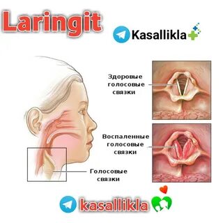 Острый обструктивный ларингит
