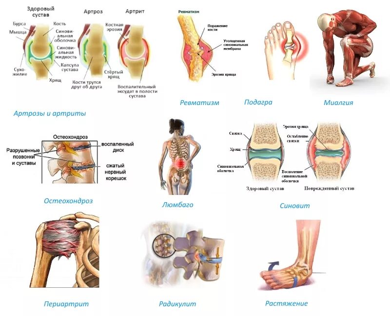 Артрита инструкция по применению цена. Заболевание суставов название. Артрит артроз остеохондроз. Болезнь костей и суставов название.