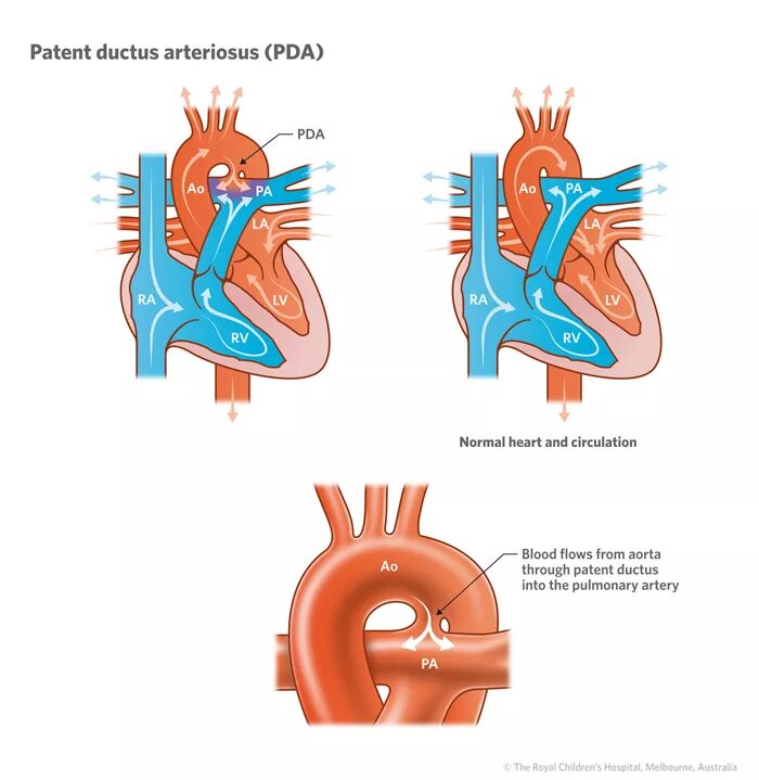 Plexus arteriosus. Patent ductus arteriosus. дуктус артериозус. дуктус зависимые пороки сердца у новорожденных. perzistující ductus arteriosus.