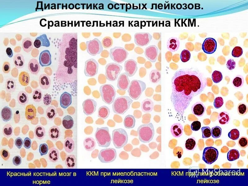 острый плазмобластный лейкоз. миелоидный лейкоз картина крови. острый и хронический миелобластный лейкоз. хронический миелолейкоз анализ костного мозга. бластный криз при остром лейкозе.