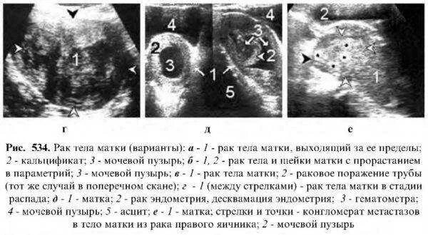 Рецидив рака шейки. Злокачественная опухоль шейки матки. Раковые изменения на шейке матки. Раковые новообразования.