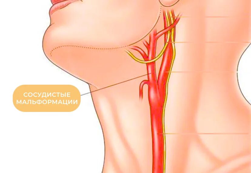 Брахиоцефальные артерии что это и где находится. Брахиоцефальные артерии (бца). каротидная эндартерэктомия. атеросклероз сонных артерий. каротидная эндартерэктомия сонной артерии.