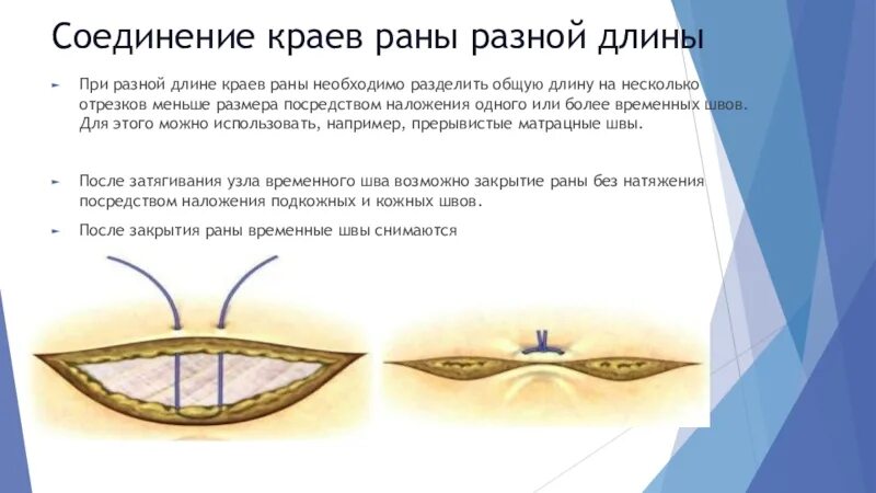 Сведение краев раны. Пластырь соединяющий края раны. Сведение вместе краев раны.