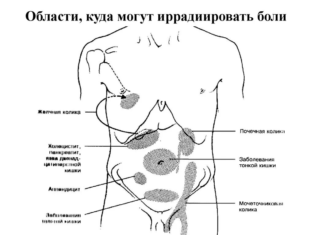 Зоны брюшной полости схема. Схема боли в животе. Локализация боли в брюшной полости. Боль в надчревной области живота.