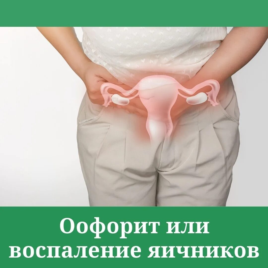 Какие симптомы при воспалении яичников у женщины. Воспалительные заболевания яичников.
