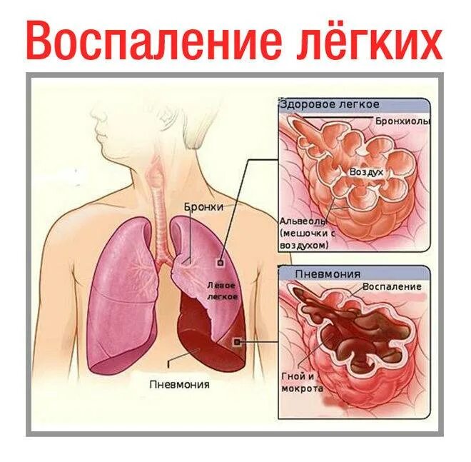 Боль в легких. Пневмония презентация. лёгкие больного пневмонией.