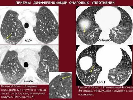 Последствия фиброза легких