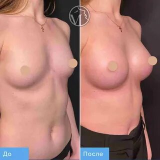 Как делают увеличение груди? 