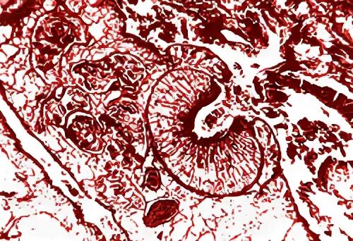 эхинококкоз желчного пузыря. суперинвазионный описторхоз. симптомы заражения описторхозом. описторхоз желчные протоки. описторхоз гистология.