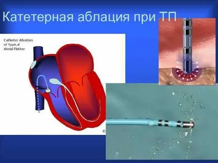 Аблация