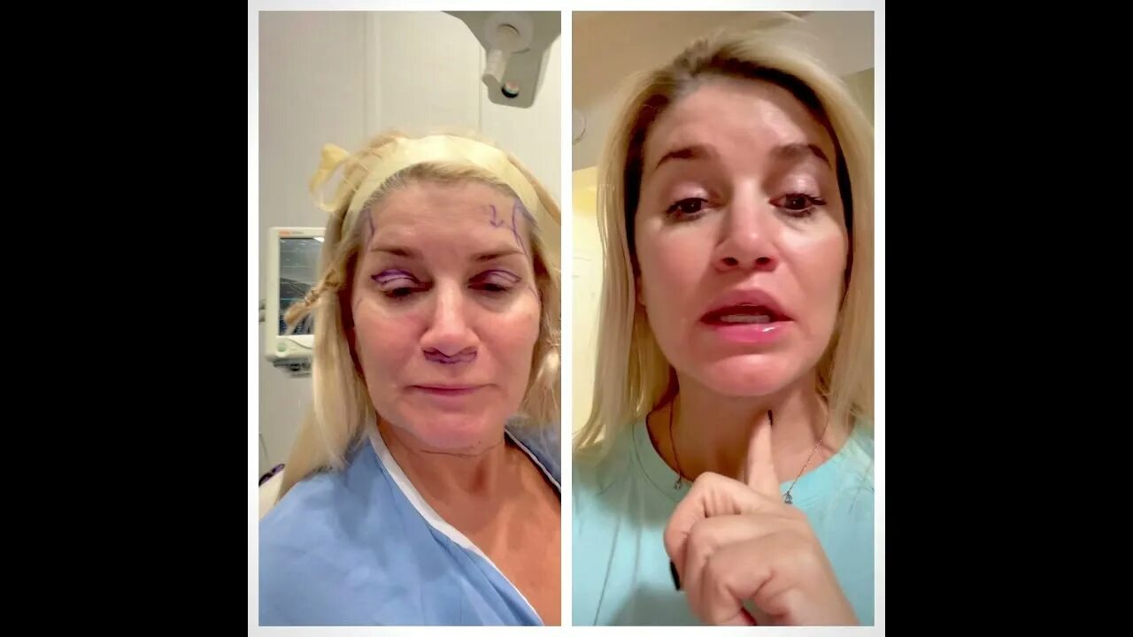Аксесс фейслифт. American plastic surgery center. Эндрю джаконо пластический хирург. Deep plane facelift edema. Deep plane facelift.