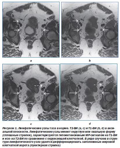 Лимфатические узлы малого таза мрт. Подвздошные лимфатические узлы мрт. Лимфоузлы малого таза на мрт. Лимфатические узлы малого таза мрт анатомия. Подвздошная лимфаденопатия
